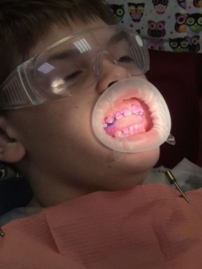 Цветная проверка чистоты зубов: новый подход к гигиене